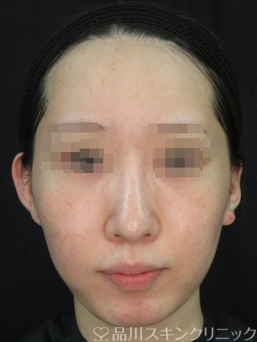 症例NO.73176のBEFORE写真