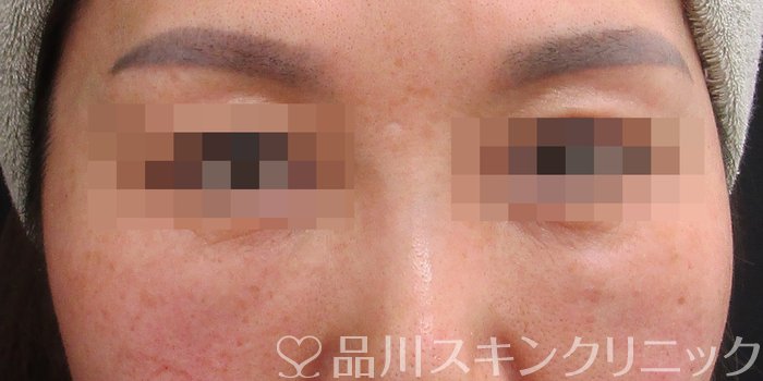 症例NO.72992のAFTER写真