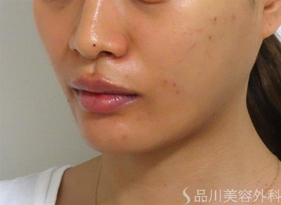 症例NO.37981のAFTER写真