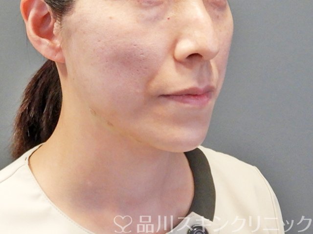 症例NO.68460のAFTER写真