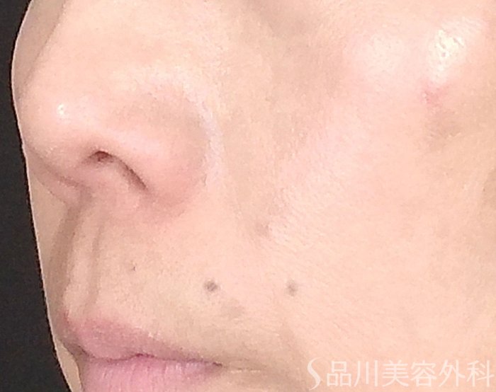 症例NO.64747のAFTER写真