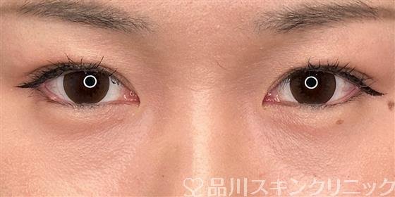 症例NO.59287のAFTER写真