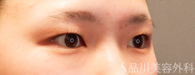 症例NO.70028のBEFORE写真