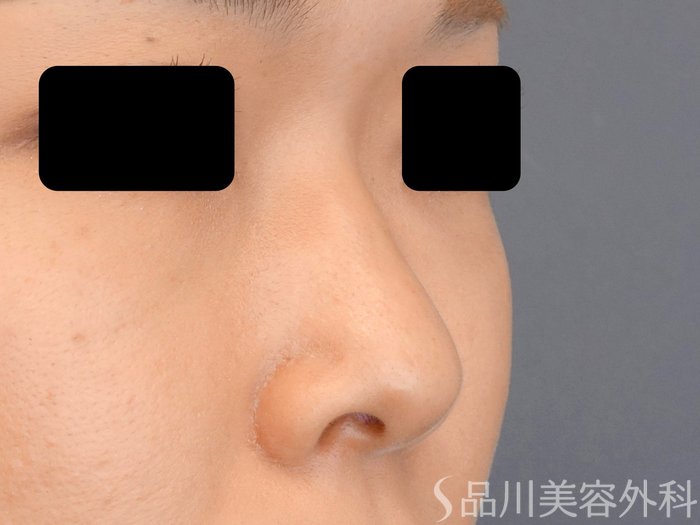 症例NO.70928のBEFORE写真