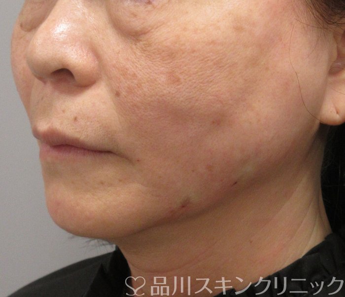 症例NO.74802のAFTER写真