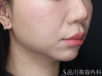 症例NO.69388のAFTER写真
