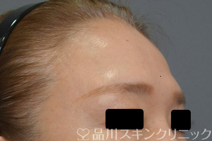 症例NO.74587のBEFORE写真