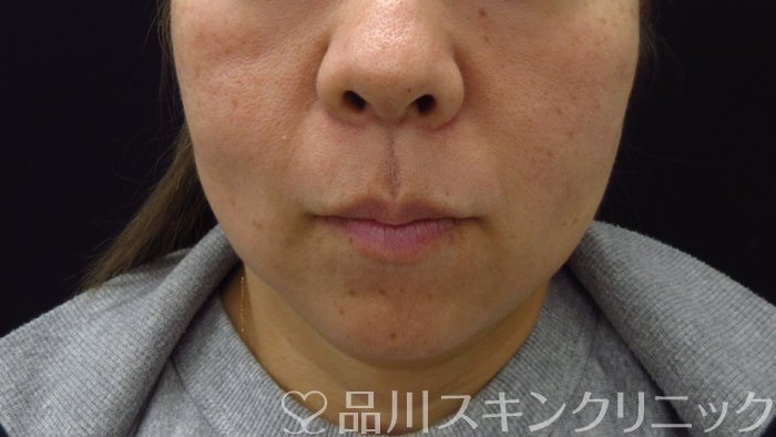 症例NO.74367のAFTER写真