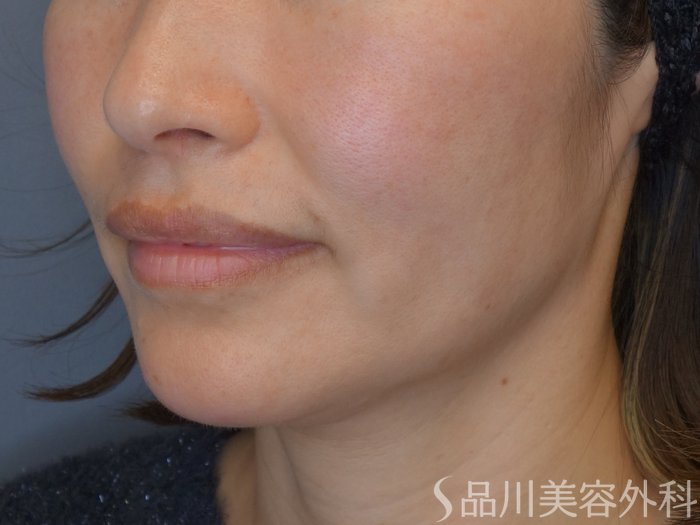症例NO.68149のBEFORE写真