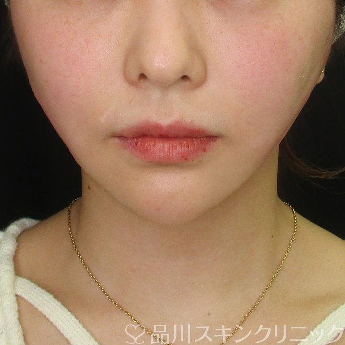 症例NO.70365のAFTER写真