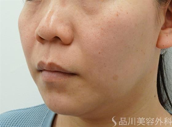 症例NO.46681のBEFORE写真
