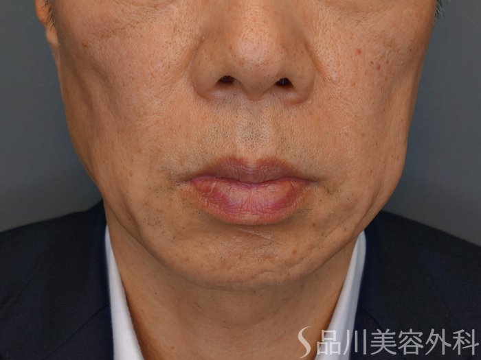 症例NO.73357のBEFORE写真