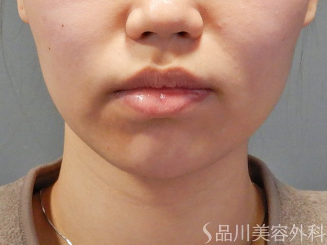 症例NO.74963のAFTER写真