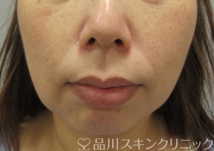 症例NO.71917のBEFORE写真