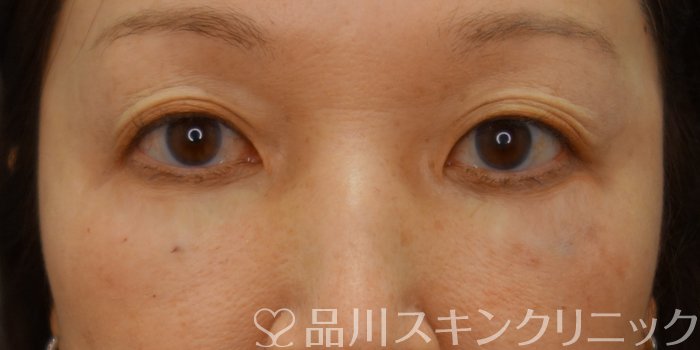 症例NO.74602のAFTER写真