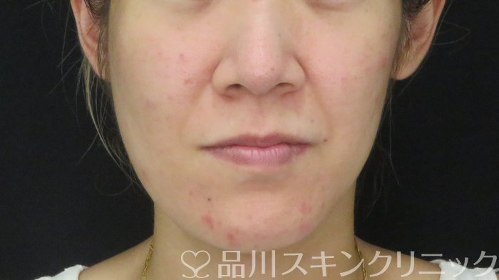 症例NO.72544のAFTER写真