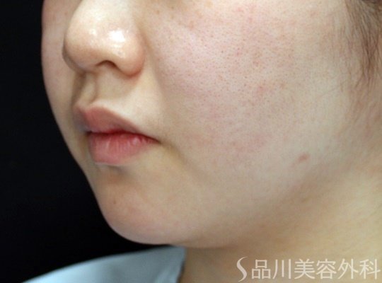 症例NO.69971のBEFORE写真