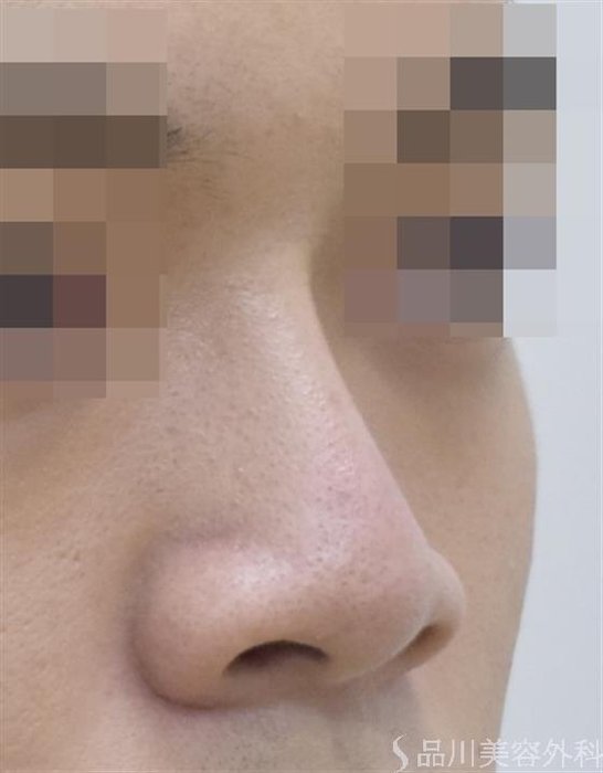 症例NO.48137のAFTER写真