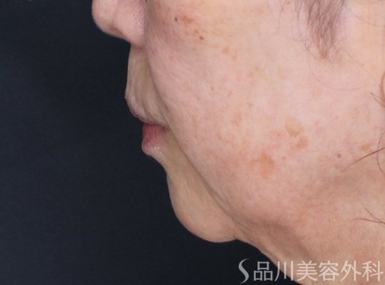 症例NO.71053のBEFORE写真