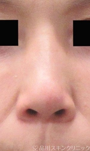 症例NO.64938のBEFORE写真