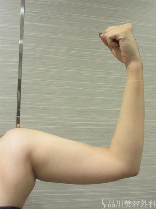 症例NO.24351のBEFORE写真