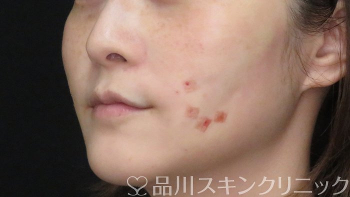 症例NO.71332のAFTER写真