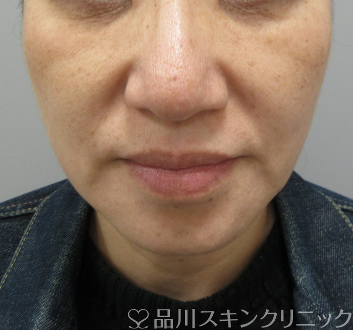 症例NO.73071のBEFORE写真