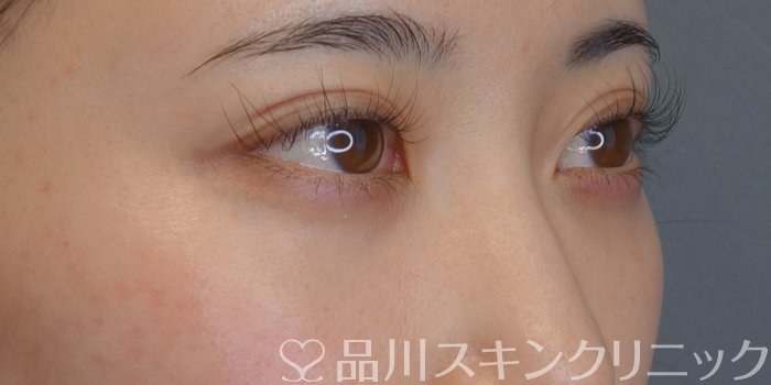 症例NO.74112のAFTER写真