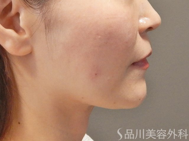 症例NO.74037のAFTER写真