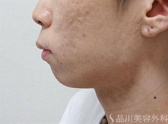 症例NO.53032のBEFORE写真