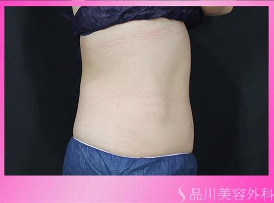 症例NO.49755のBEFORE写真