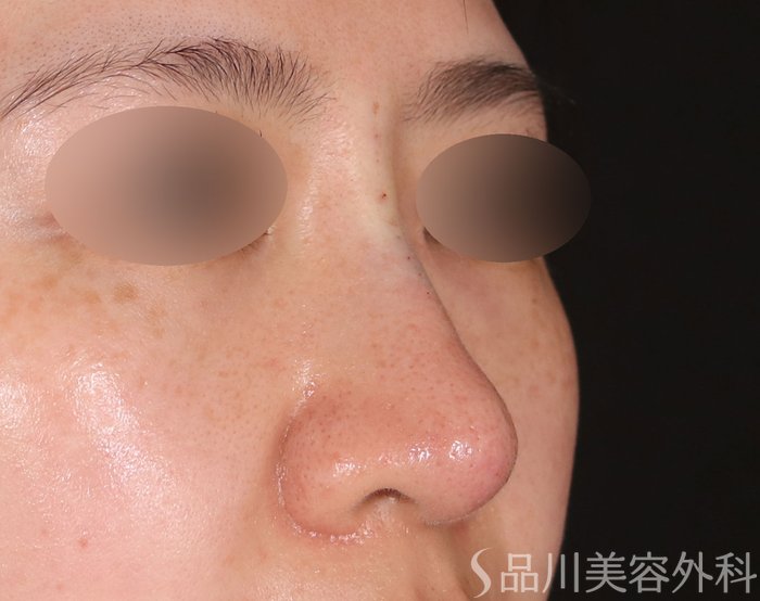症例NO.72615のAFTER写真