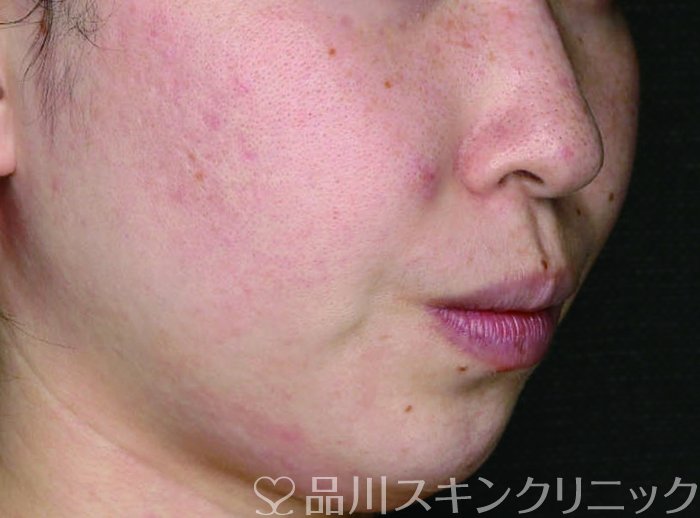 症例NO.65251のBEFORE写真