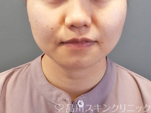 症例NO.63334のBEFORE写真
