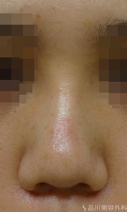 症例NO.25889のAFTER写真