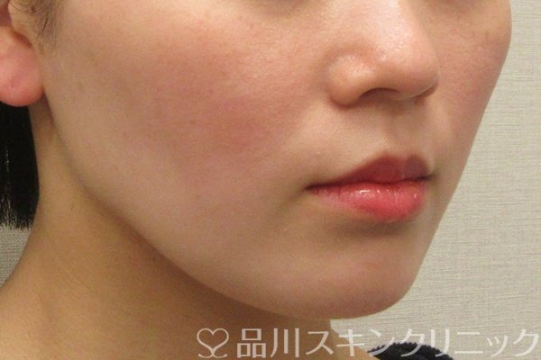 症例NO.75078のBEFORE写真