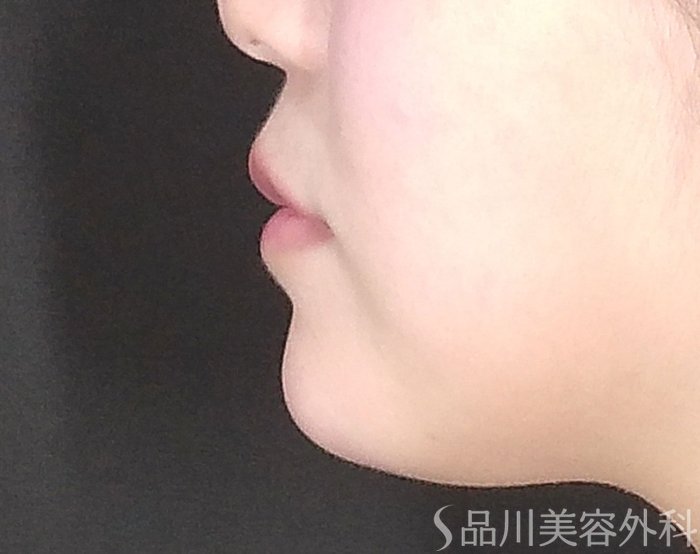 症例NO.65089のAFTER写真