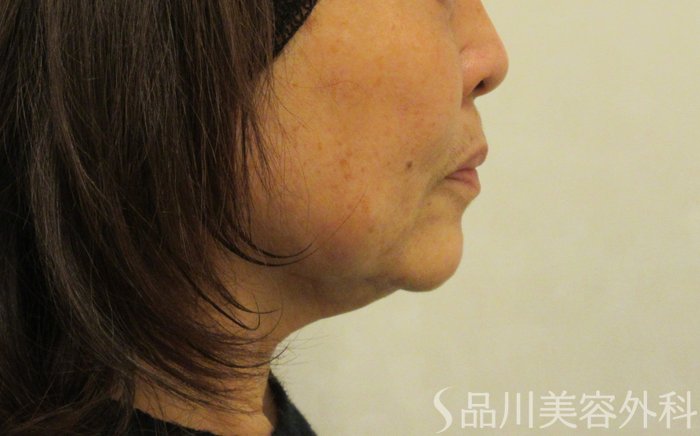 症例NO.72279のBEFORE写真