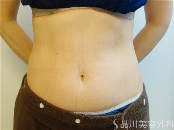 症例NO.51325のBEFORE写真