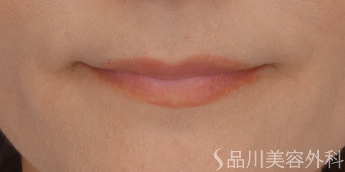 症例NO.65107のBEFORE写真