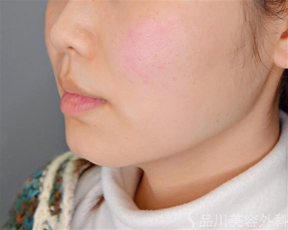 症例NO.54390のBEFORE写真