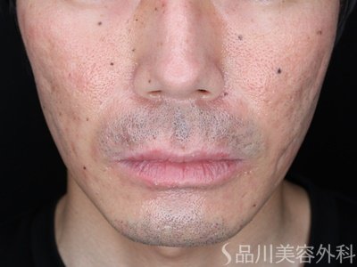 症例NO.74708のAFTER写真