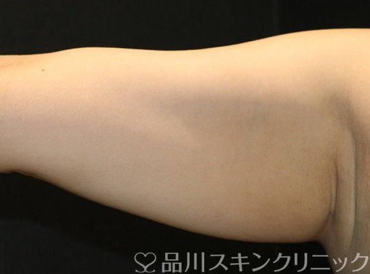 症例NO.75303のBEFORE写真