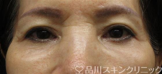 症例NO.61364のAFTER写真