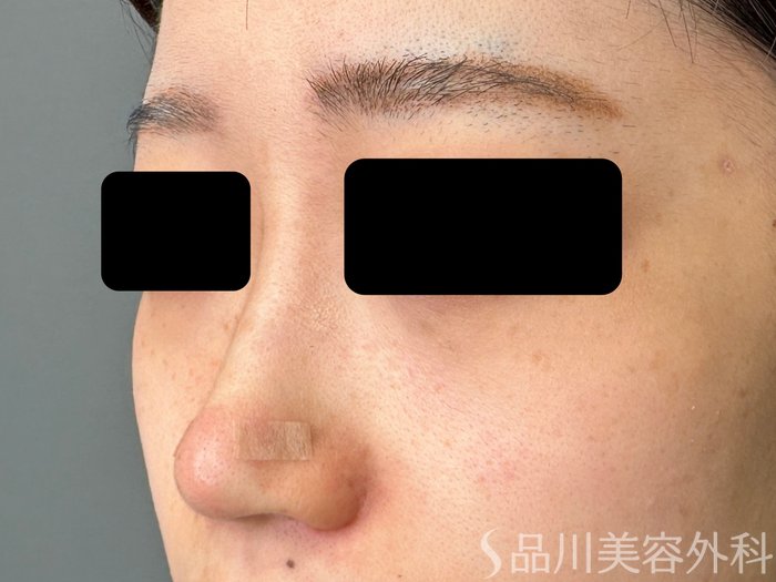 症例NO.74882のAFTER写真