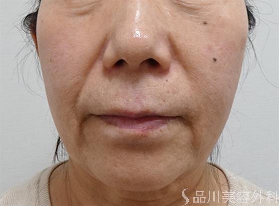 症例NO.53641のBEFORE写真