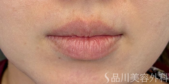 症例NO.71409のBEFORE写真