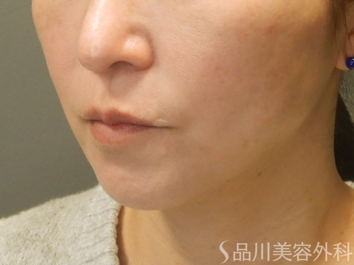 症例NO.70357のAFTER写真