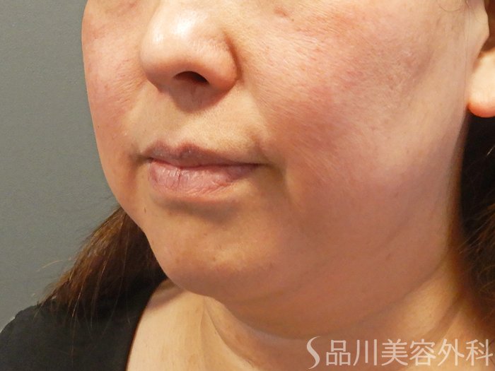 症例NO.70443のBEFORE写真
