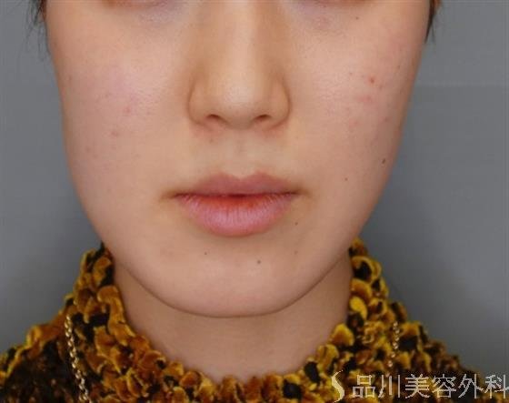 症例NO.51056のBEFORE写真